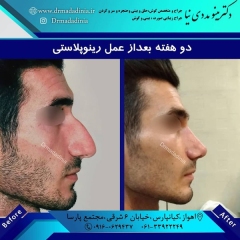 جراحی-بینی-اهواز-302