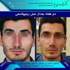 جراحی-بینی-اهواز-303