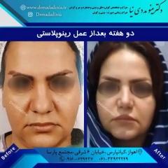 جراحی-بینی-اهواز-304