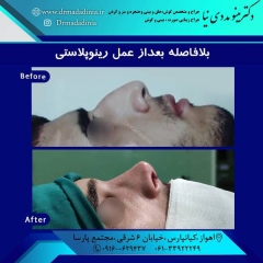 جراحی-بینی-اهواز-300