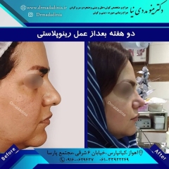 جراحی-بینی-اهواز-305