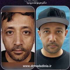 rhinoplasty-334
