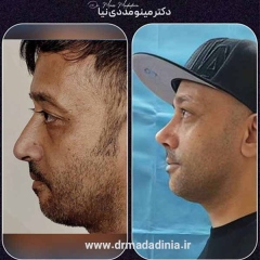 rhinoplasty-335