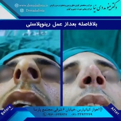 جراحی-بینی-اهواز-295