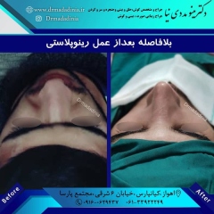 جراحی-بینی-اهواز-301
