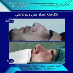 جراحی-بینی-اهواز-299