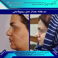 جراحی-بینی-اهواز-306