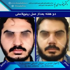 جراحی-بینی-اهواز-308