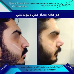 جراحی-بینی-اهواز-309