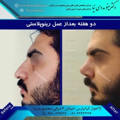 جراحی-بینی-اهواز-310