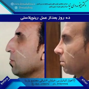 جراحی-بینی-اهواز-313