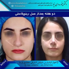 جراحی-بینی-اهواز-324