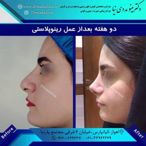 جراحی-بینی-اهواز-326