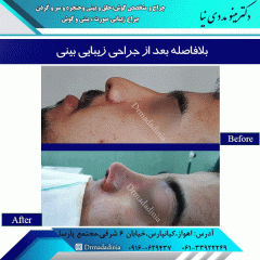 جراحی-بینی-320