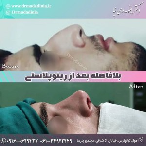 جراحی-بینی-330