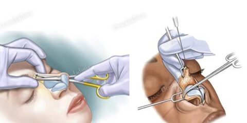 تفاوت جراحی بینی باز و بسته