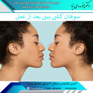 سوهان کشی بعد از جراحی بینی