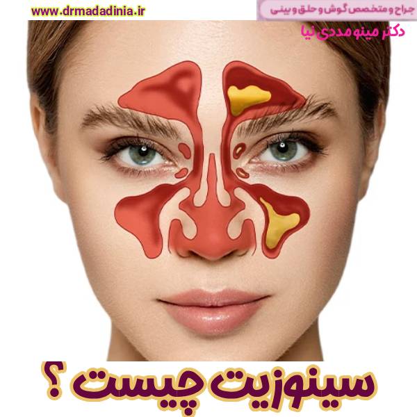 سینوزیت - دکتر مینو مددی نیا