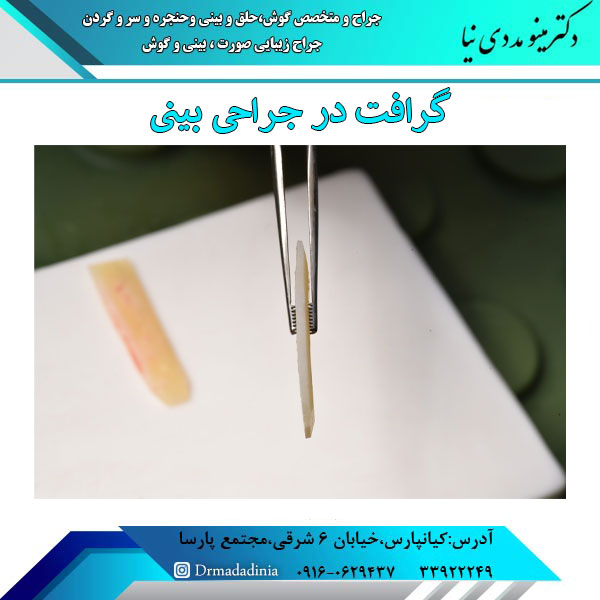 گرافت در جراحی بینی